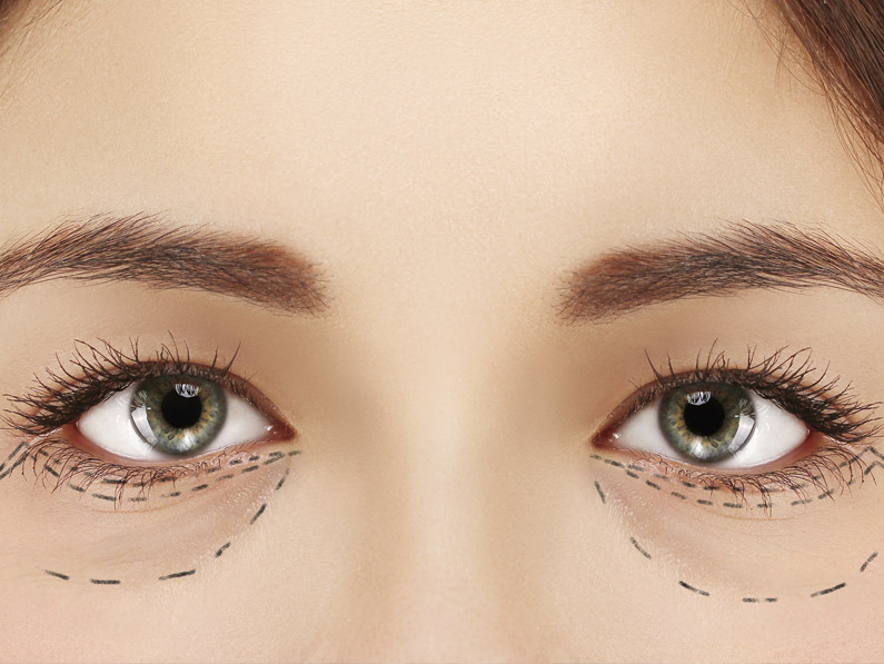 Eyelid Procedures at Eye Care Associates of Nevada in Sparks, NV