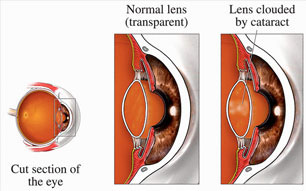 Cataracts at Eye Care Associates of Nevada in Winnemucca, NV