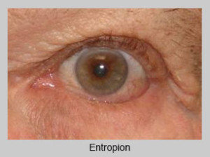 Ectropion Repair at Eye Care Associates of Nevada