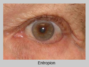 Ectropion Repair at Eye Care Associates of Nevada in Elko, NV