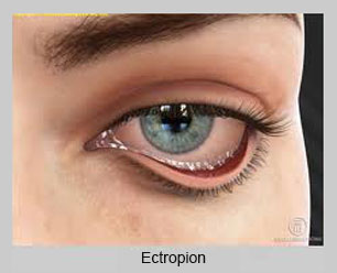 Entropion at Eye Care Associates of Nevada in Winnemucca, NV
