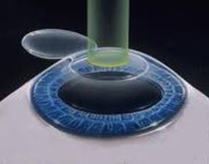 Refractive Surgery Options at Eye Care Associates of Nevada in Sparks, NV