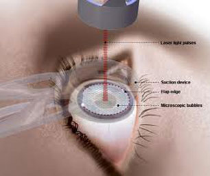 Laser Vision Correction at Eye Care Associates of Nevada