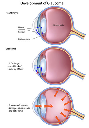 Glaucoma Treatment at Eye Care Associates of Nevada in Hidden Valley, NV