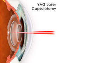 YAG Laser Procedure at Eye Care Associates of Nevada